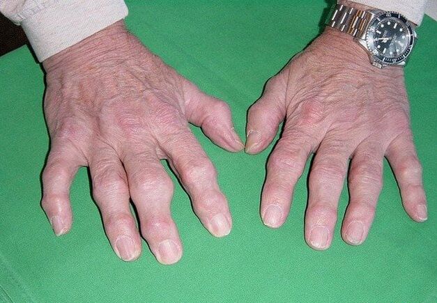 Finger osteoarthritis