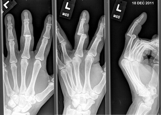 X-ray of finger dislocation