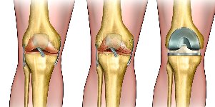 the development of osteoarthritis