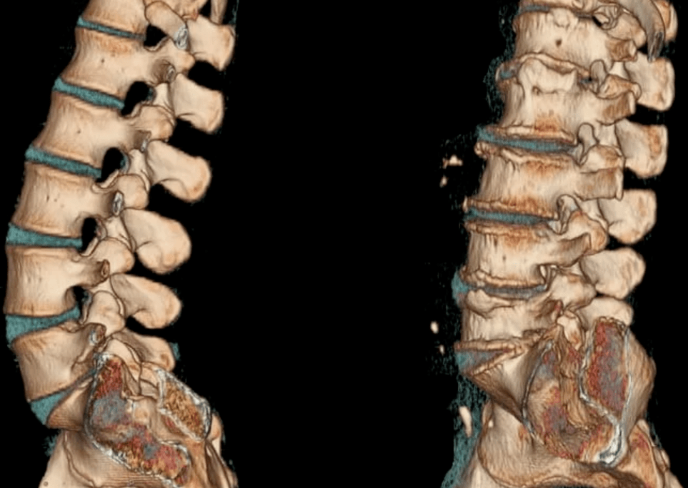 Osteochondral disease