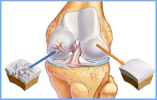Normal knee joint affected by arthropathy