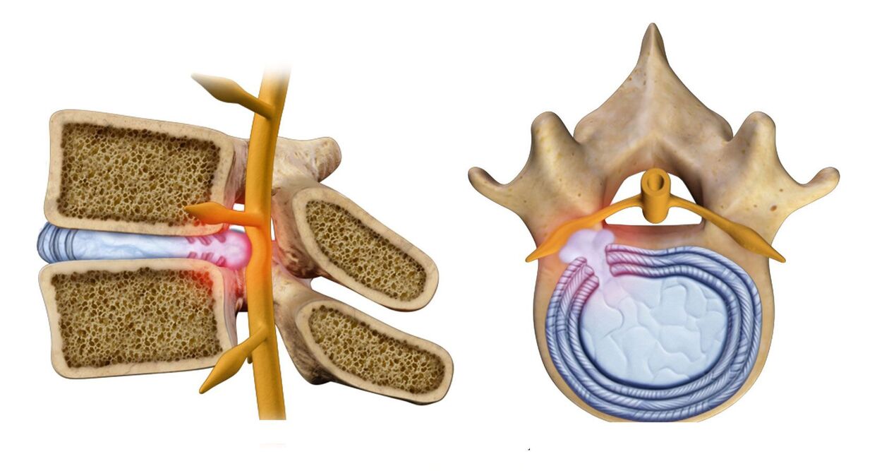 thoracic osteochondrosis spinal hernia