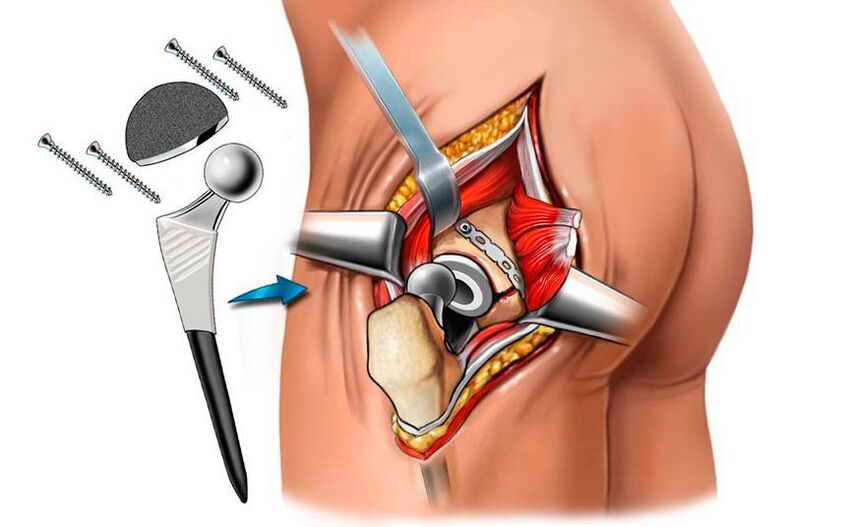 Fitting an endoprosthesis - a surgical approach to hip problems