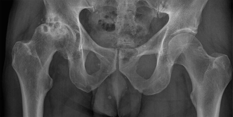 Hip deformed joint on x-ray