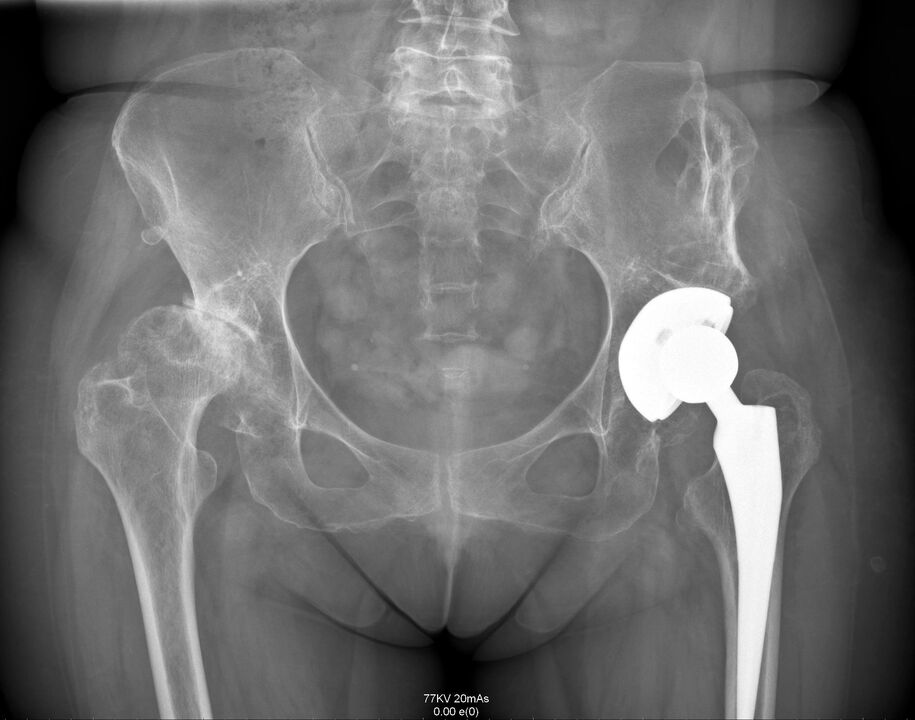 X-ray of the hip joint after joint replacement