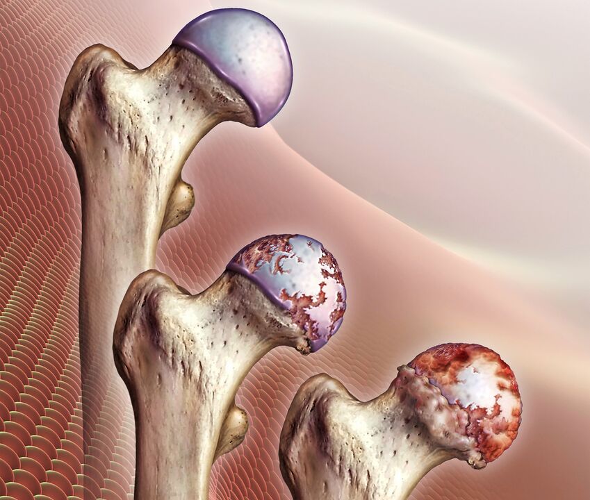 development of hip joint disease