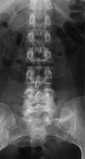 To diagnose osteochondrosis of the lumbar spine, radiographic examination is required
