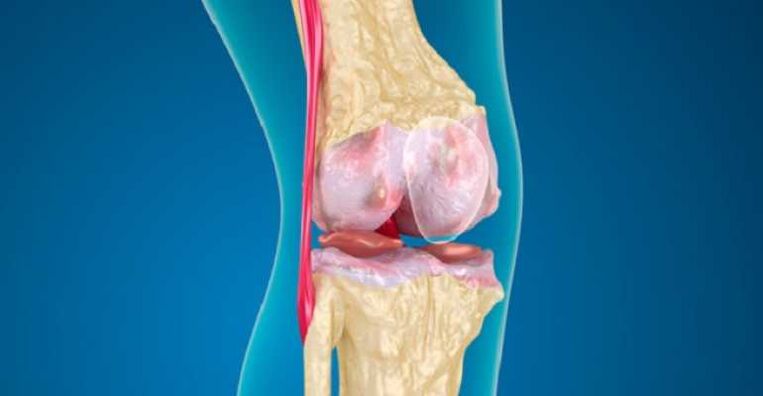 Arthritis of knee joint disease, leading to damage to joint cartilage