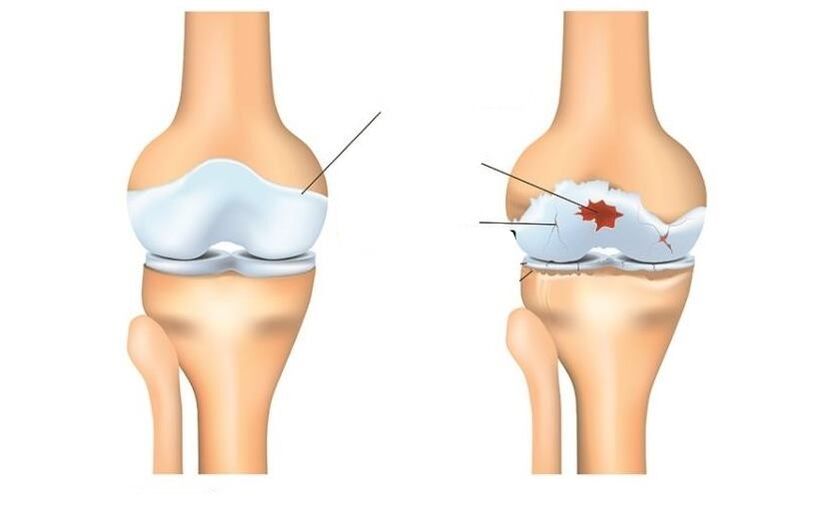 Joint health and patients