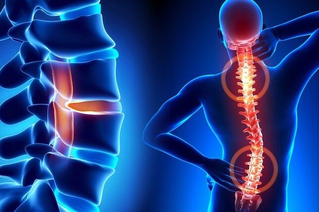 spinal osteochondrosis