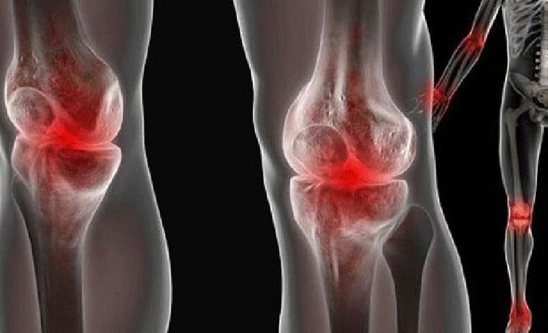 Symptoms of articular cartilage disease