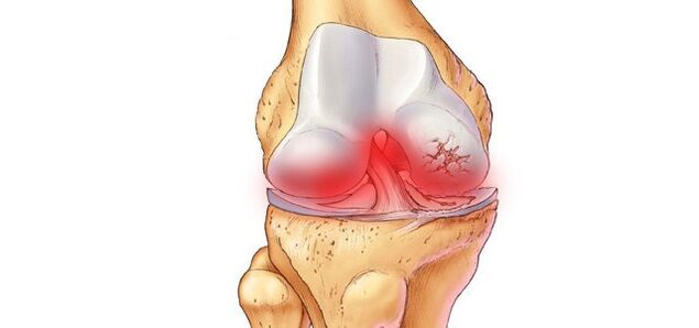 What does knee osteoarthritis look like