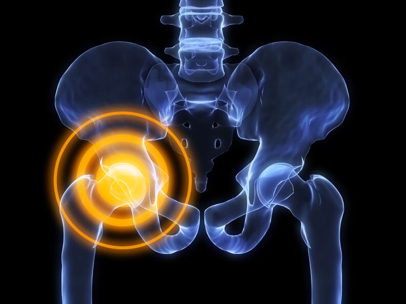hip arthrosis