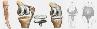 Arthroplasty, for example the knee