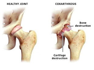 comparison of a joint healthy and zustavas coxarthrosis